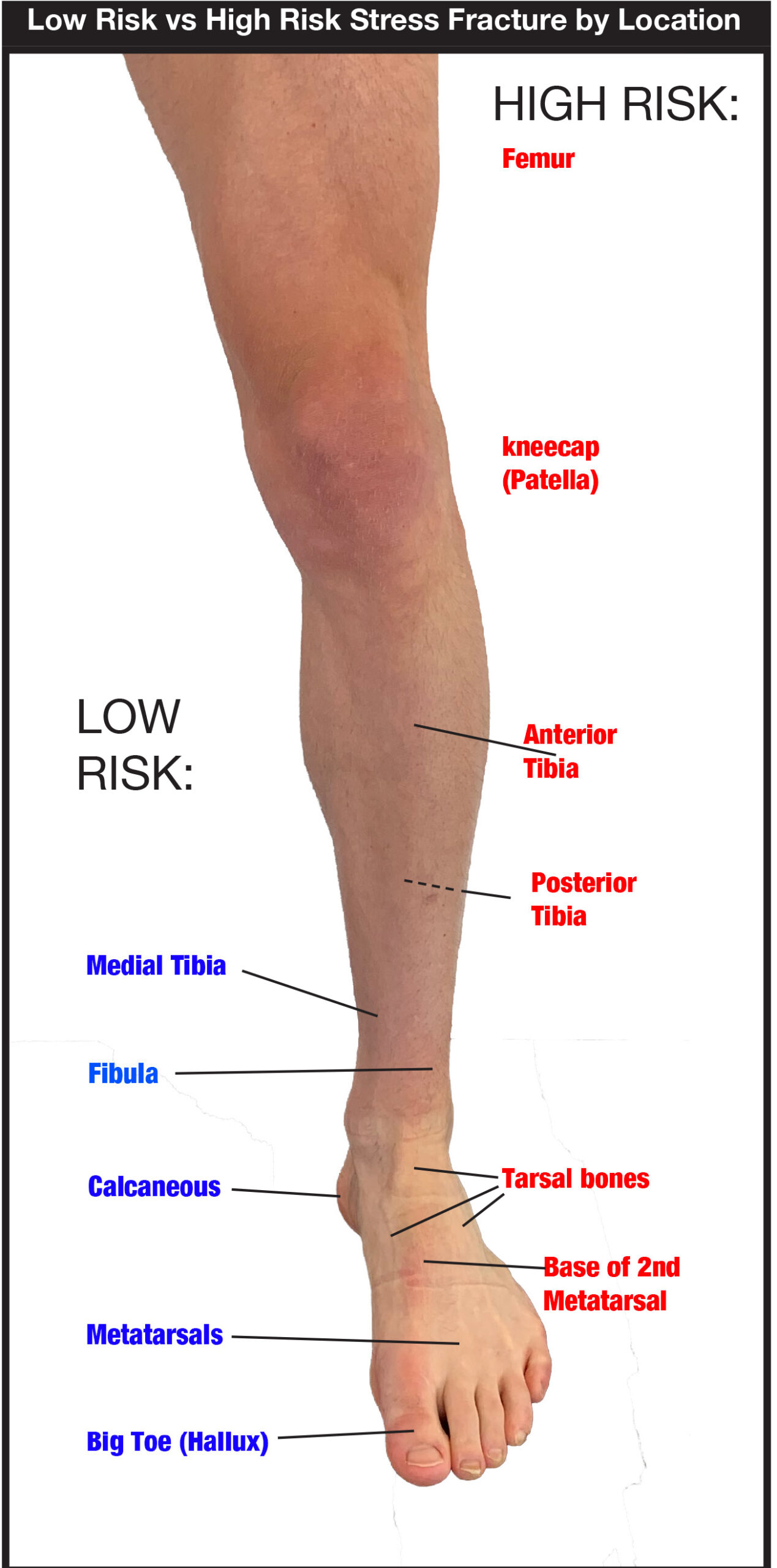 Stress Fracture Risk by Location cropped scaled