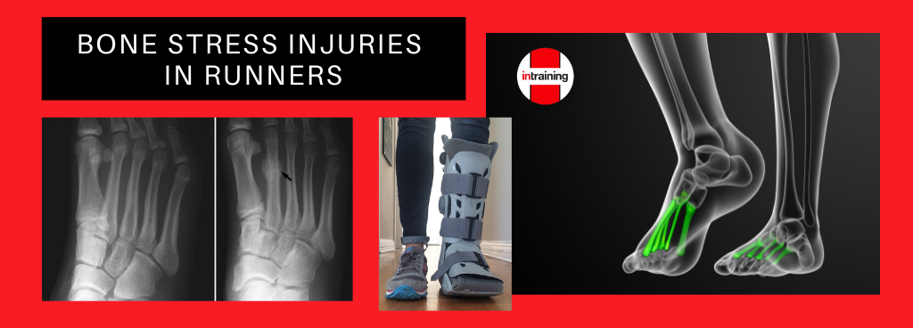 Bone stress injuries in runners